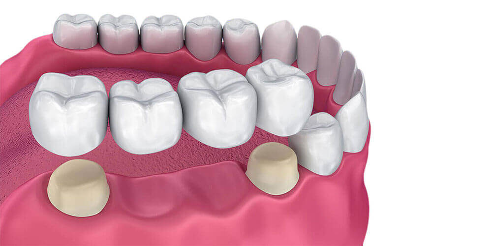 Dental crowns and bridges Dental crowns and bridges