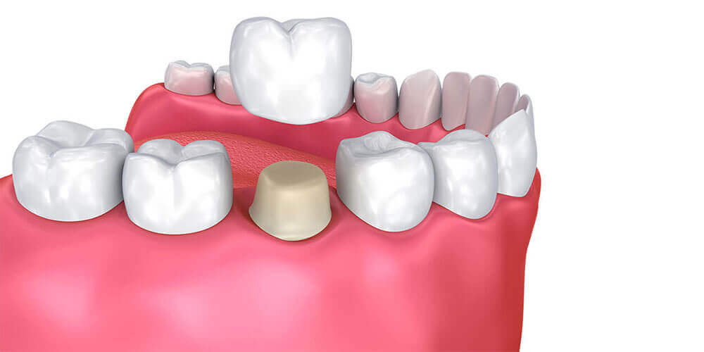 Dental crowns and bridges Etobicoke