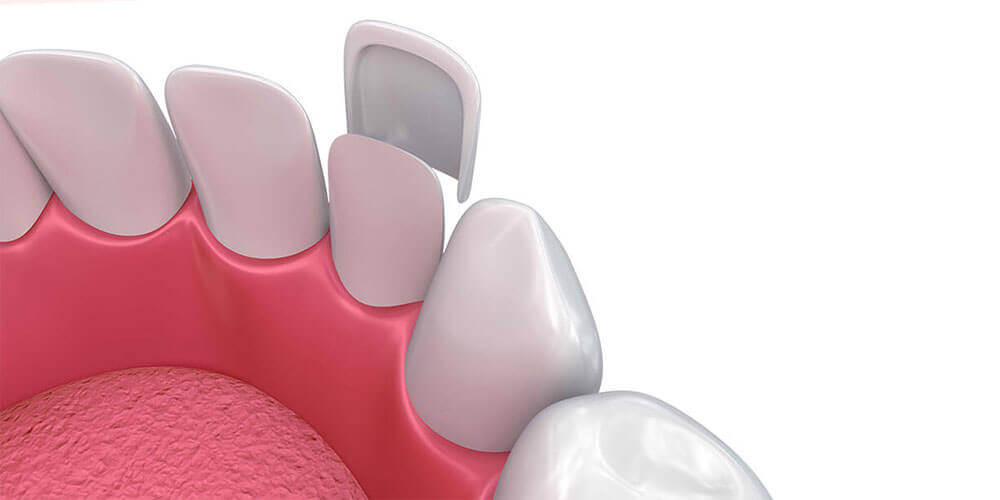 Dental Veneers Etobicoke