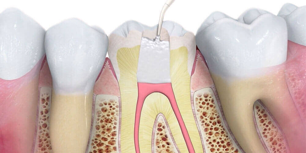 Root Canal Treatment Etobicoke